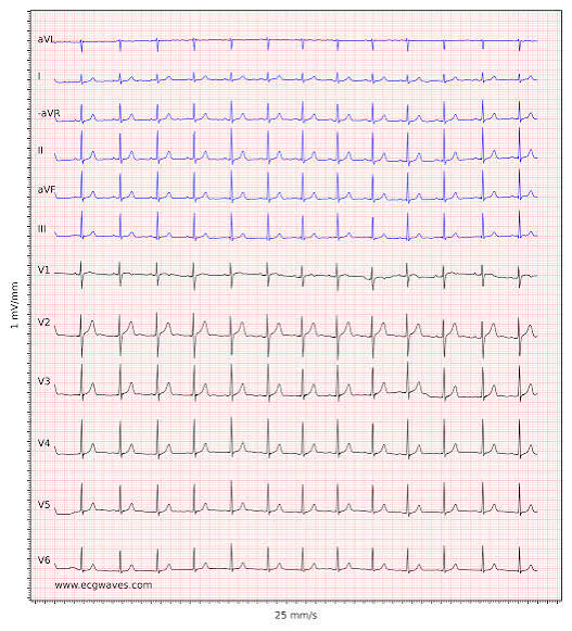 Matériel utilisé pour ECG