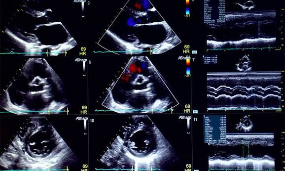 Illustration de l'examen Échocardiographie