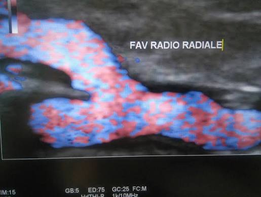 Illustration de l'examen Échodoppler des fistules artério-veineuses