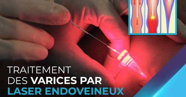 Illustration de l'examen traitement des varices par laser